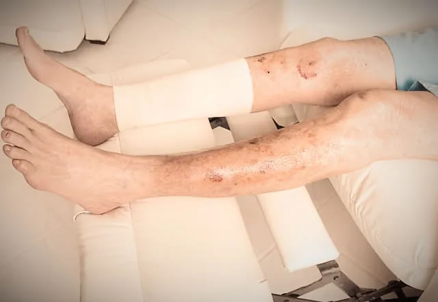 Úlceras Venosas e Arteriais
